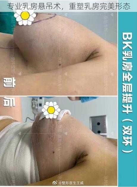 专业乳房悬吊术，重塑乳房完美形态